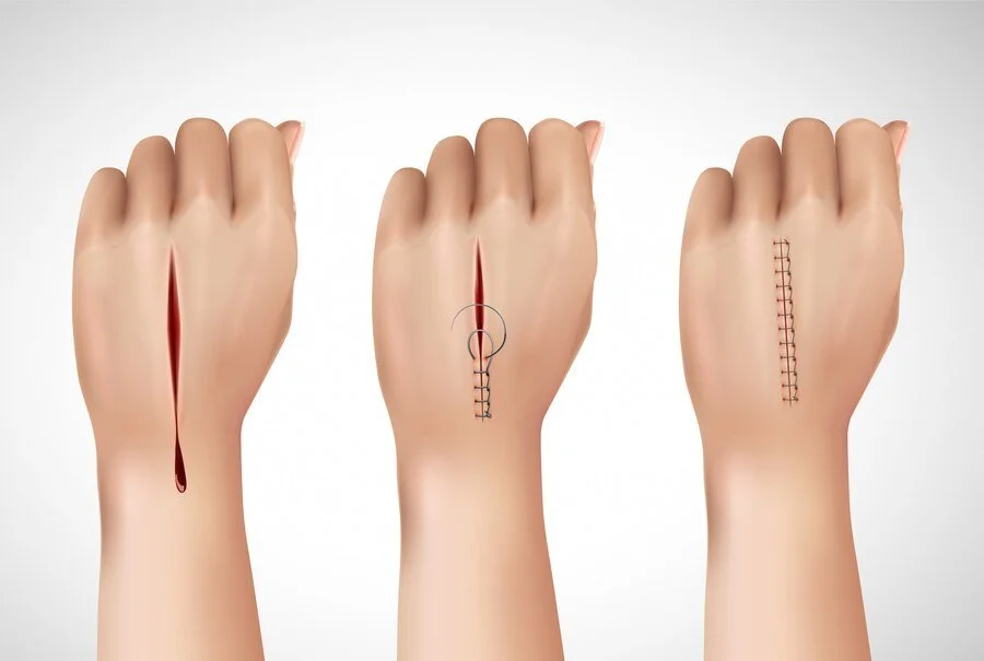 Chronic Wounds Treatment in Riyadh | Saudi Arabia 1 chronic Wounds before after