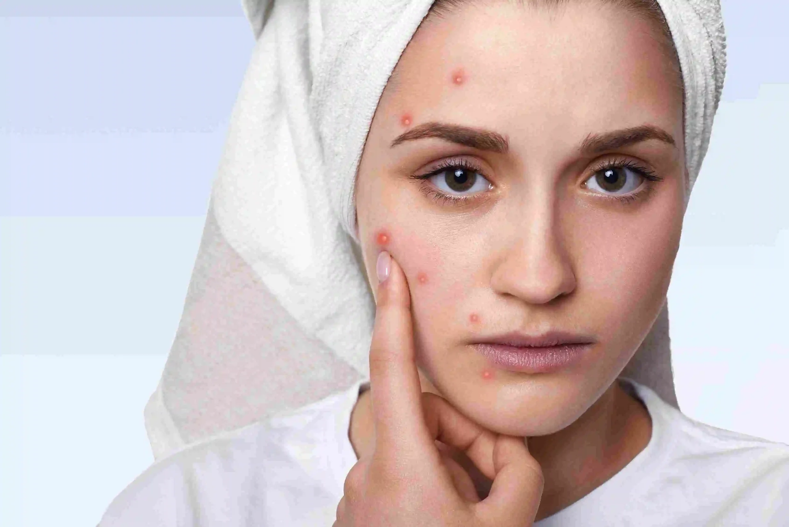 Laser Acne Treatment in Riyadh 3 Acne Treatment in Riyadh