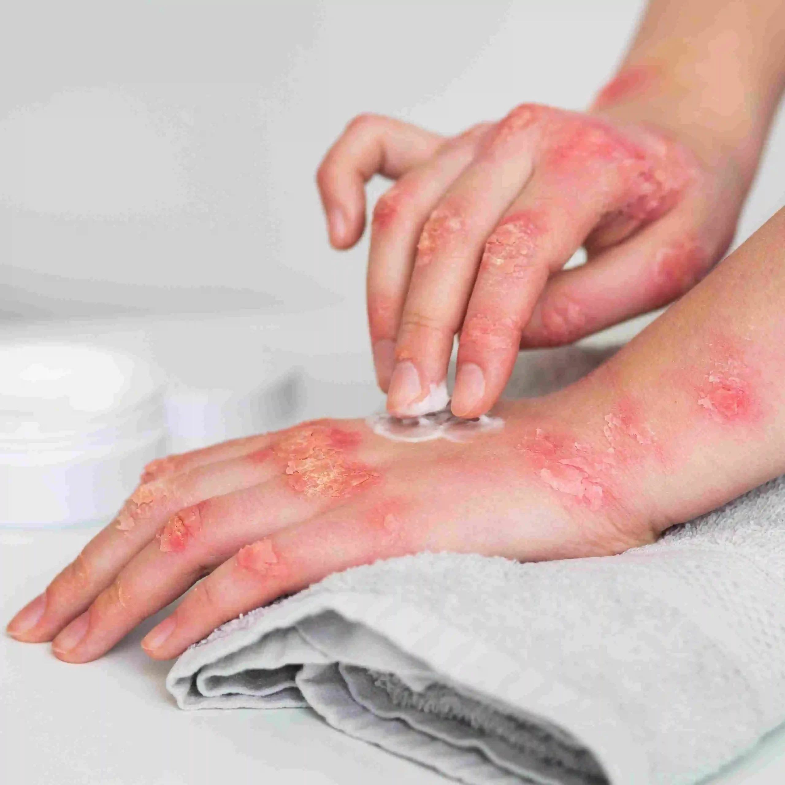 Psoriasis Treatment in Riyadh 3 Actinic Keratosis Treatment in Riyadh
