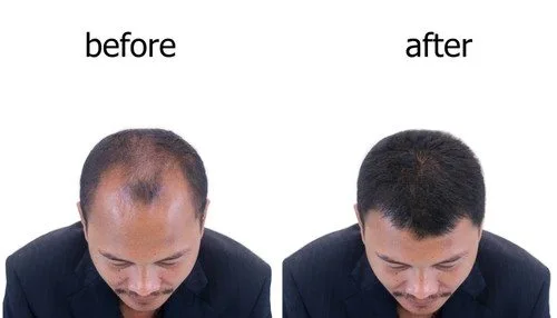 Hair Transplant Cost in Riyadh 1 Hair transpalnt before after results