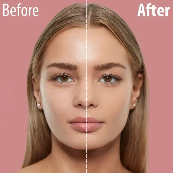 Hyaluronic Acid Injections in Riyadh 1 Hyaluronic Acid Before After Results