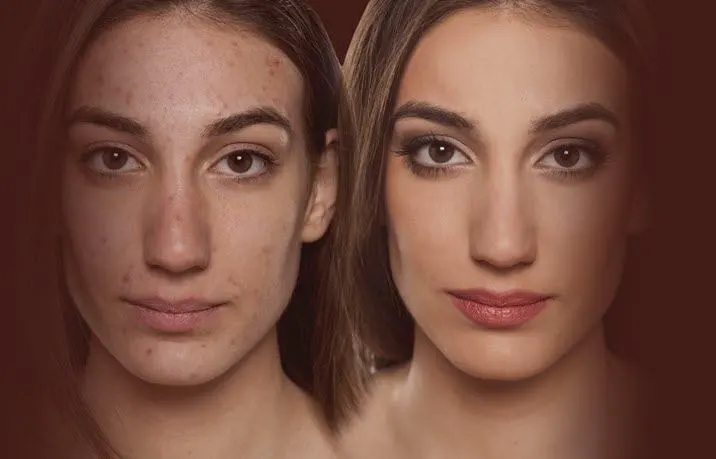 Laser Acne Treatment in Riyadh 1 Laser Acne treatment Before After