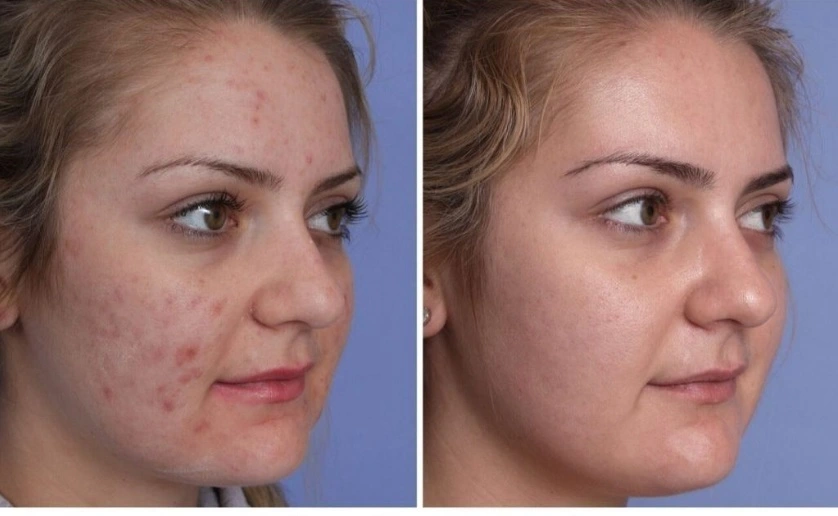 LED Light Therapy | Red Therapy in Riyadh 1 Light Red therapy Before After