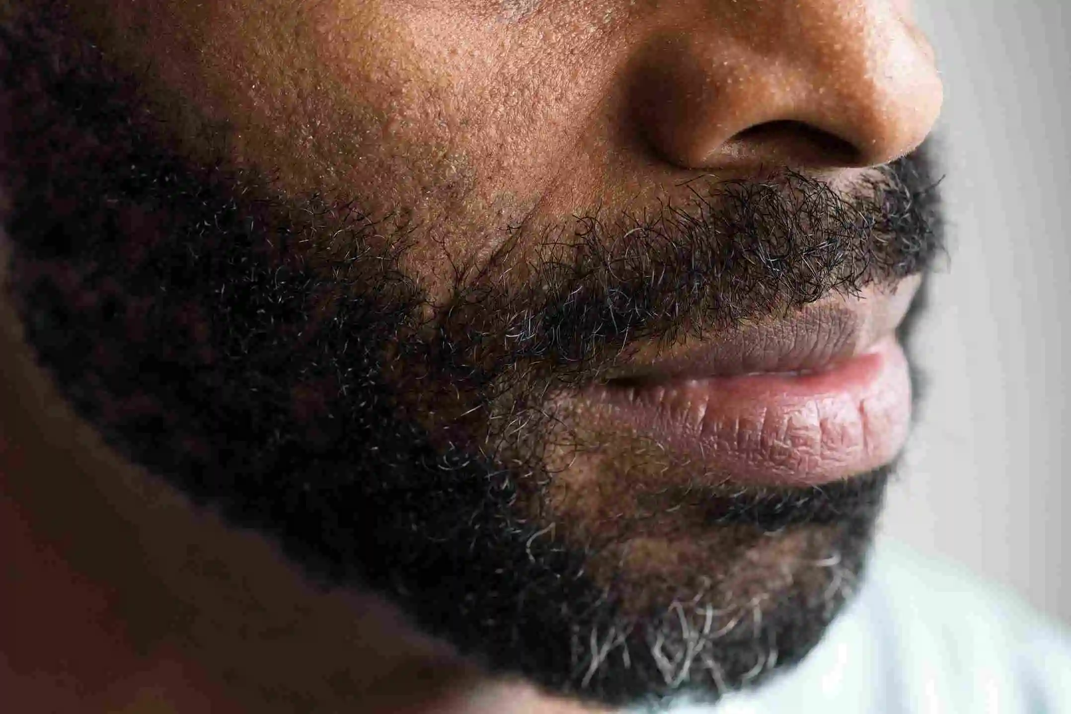 Cleft Lip Surgery in Riyadh | Saudi Arabia 7 Smokers lips treatmentTreatment in Riyadh