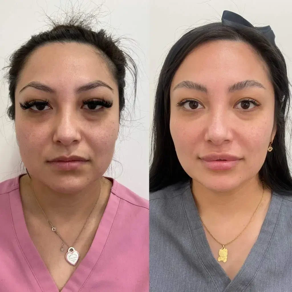 Sylfirm Treatment in Riyadh 2 Sylfrim before after