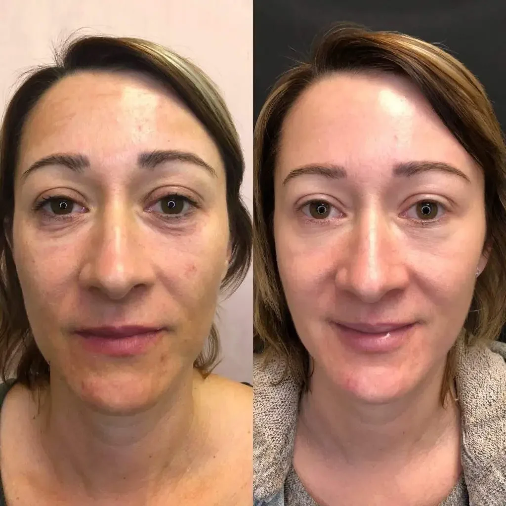 Sylfirm Treatment in Riyadh 1 Sylfrim before after resulst