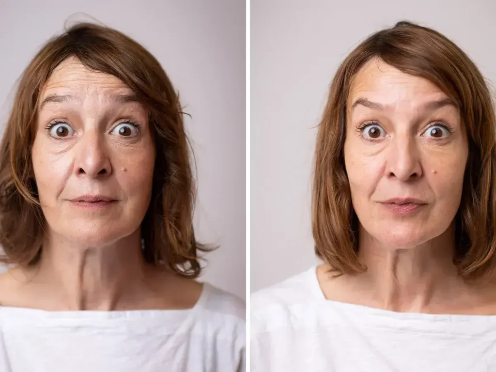 Botox Injections in Riyadh 2 botox injections before after results in riyadh
