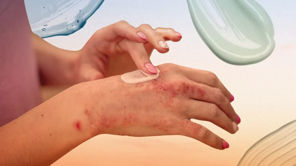 Psoriasis Treatment in Riyadh 1 Psoriasis Treatment