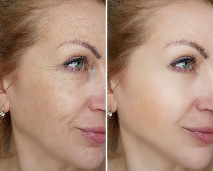 Laser Skin Resurfacing in Riyadh 1 Laser Skin Resurafacing Before After Results