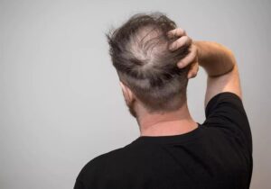guide to fue hair transplant