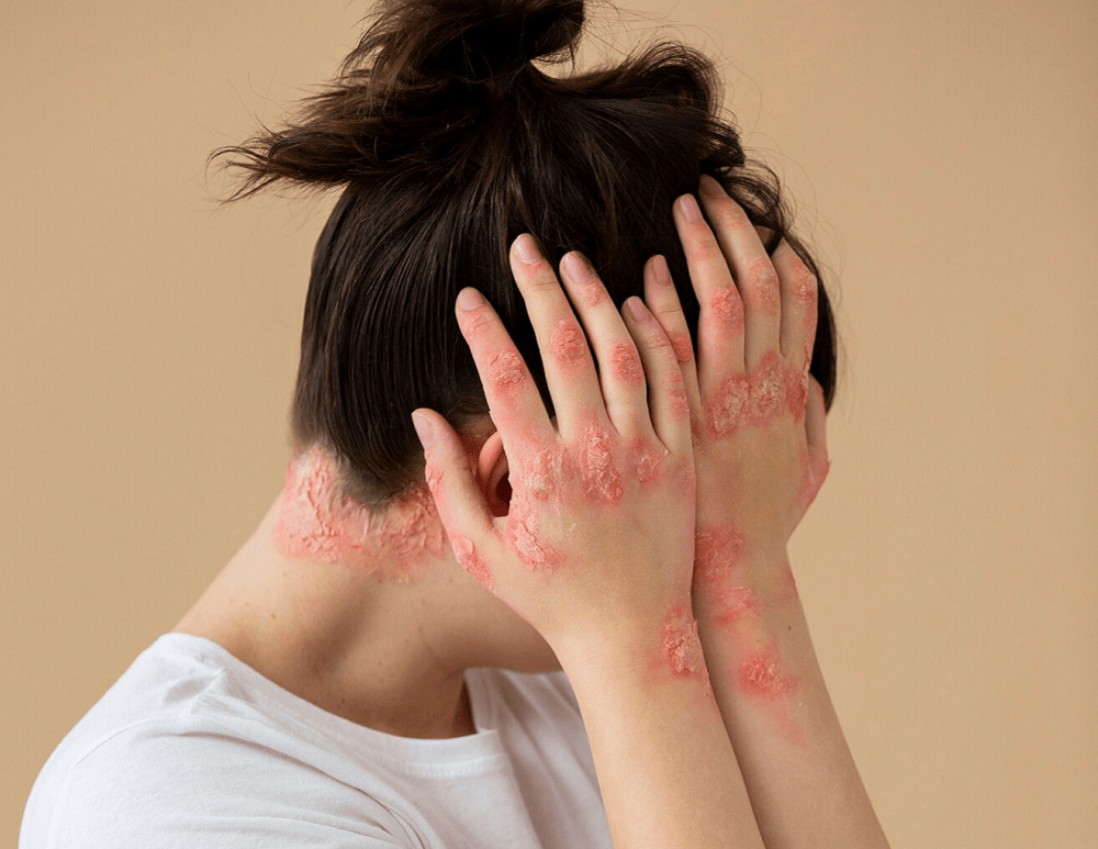 Psoriasis Treatment in Riyadh 2 Eczema Treatment in riyadh