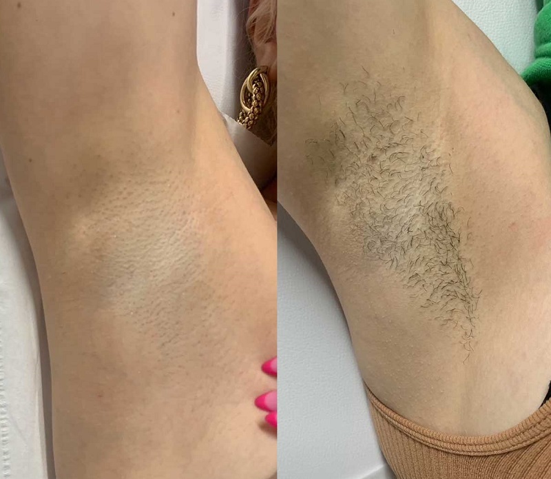 Laser Hair Removal in Riyadh 2 Laser Hair Removal Before After