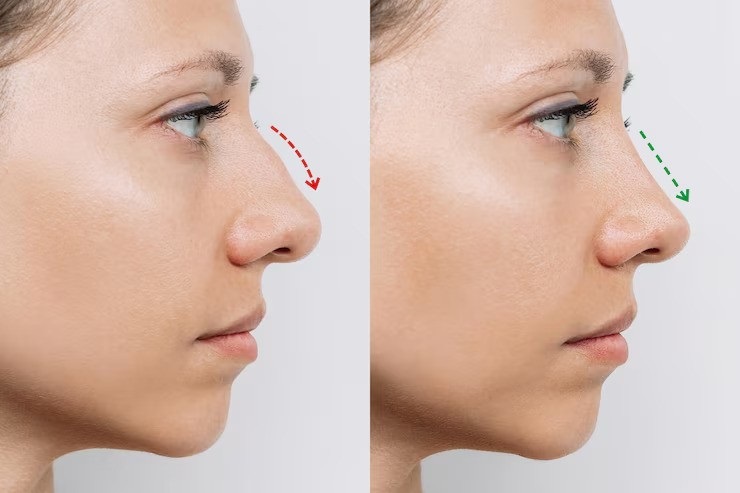 Silicone Nose Surgery in Riyadh 2 Silicone Nose surgery befroe after