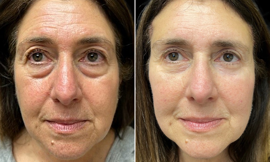 Eyelid Surgery in Riyadh 1 eyelid surgery before after results