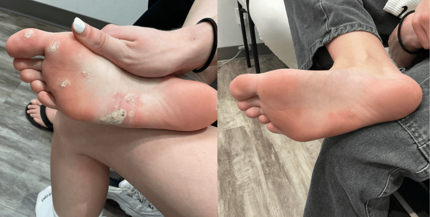 Warts Removal in Riyadh 1 warts removal before after results