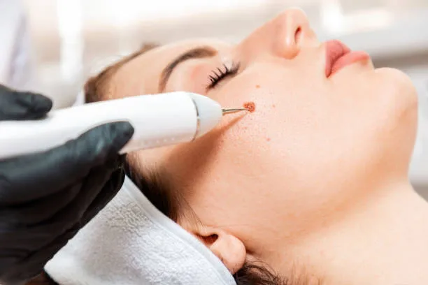 best clinic in saudi riyadh mole removal