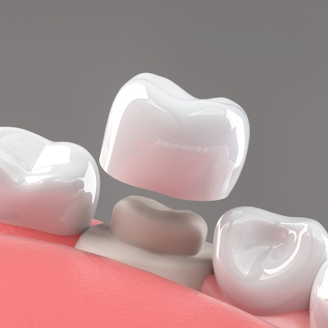 Panoramic And Cbct Teeth Xray in Riyadh 3 dental Crowns in saudia arabia