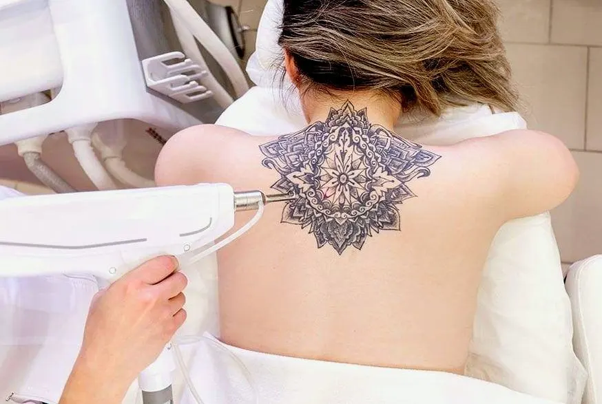 Laser Tattoo Removal in Riyadh, Saudi Arabia 4 Laser Tattoo Removal Cost in Riyadh