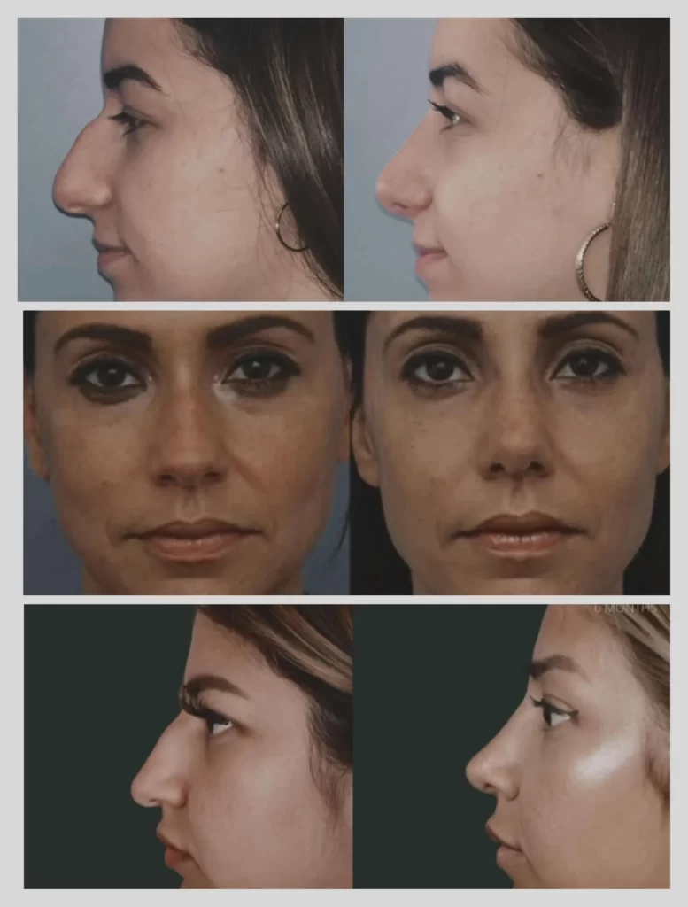 rhinoplasty before after (riyadh)
